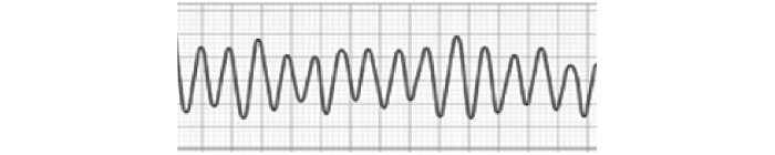 心室細動（VF）の心電図波形