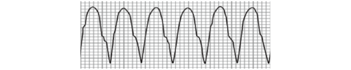 無脈性心室頻拍（P-VT）の心電図波形