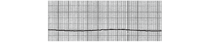 心静止（Asystole）の心電図波形